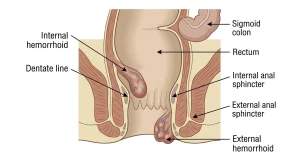 causes of piles and complete guide to Piles Treatment in Bangladesh-Dr. Nazrul Islam